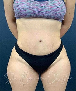 Tummy Tuck