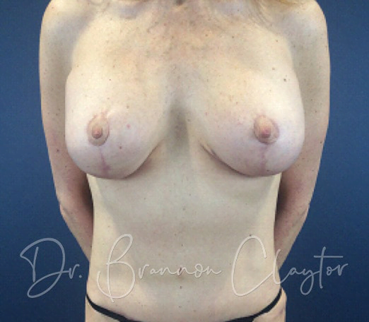 Breast Lift with Implant