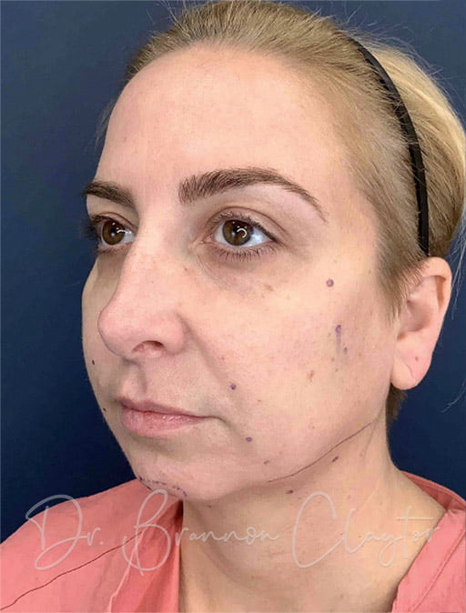 patient before silhouette instalift shows jowls and facial descent, as well as sunken cheeks