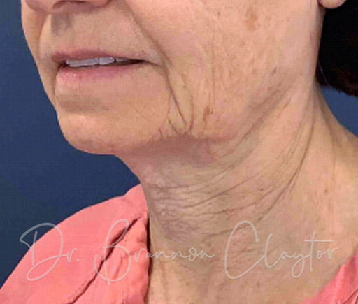 Neck Lift