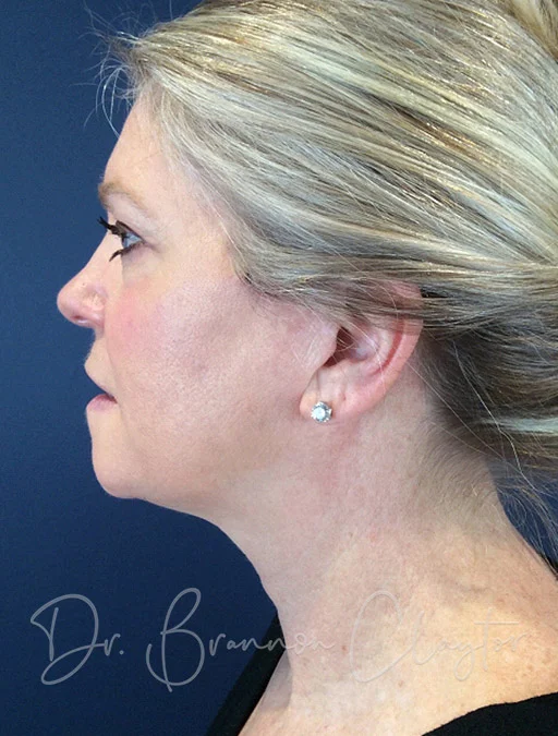 Non-surgical Neck Lift