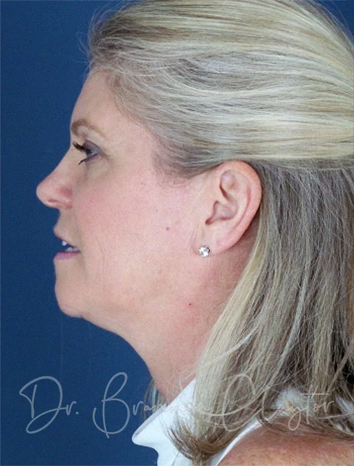 Non-surgical Neck Lift