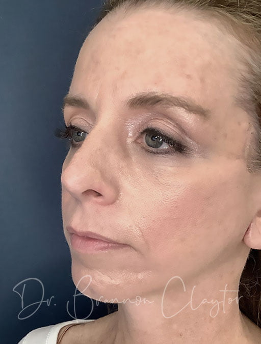 Patient of Dr. Claytor's after a facelift