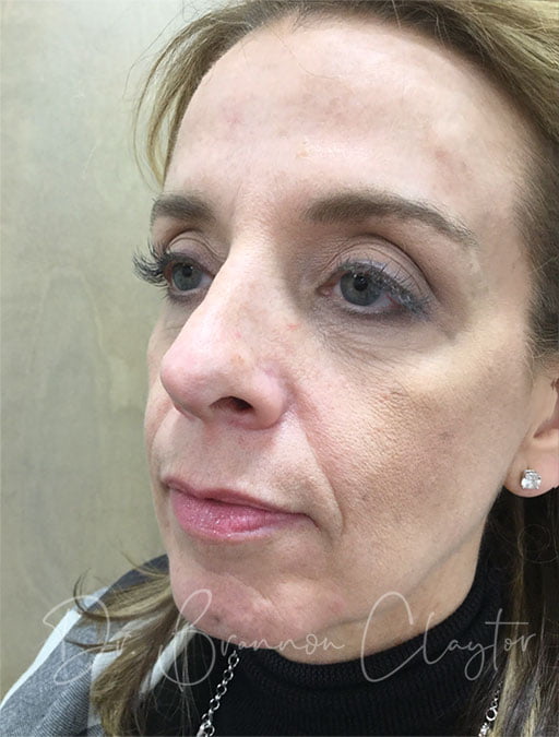 Patient of Dr. Claytor's before a facelift