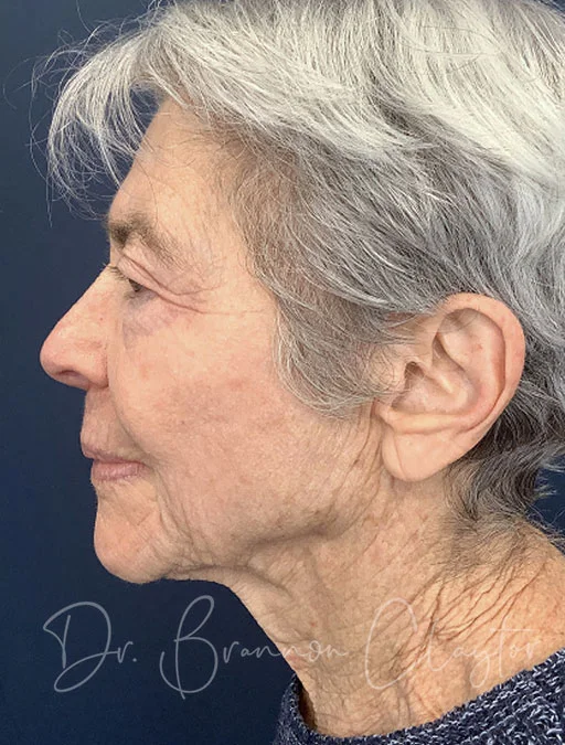 Facelift & Eyelid Lift