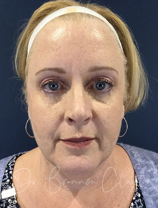 facelift-neck-jawline-liposuction-101a-before