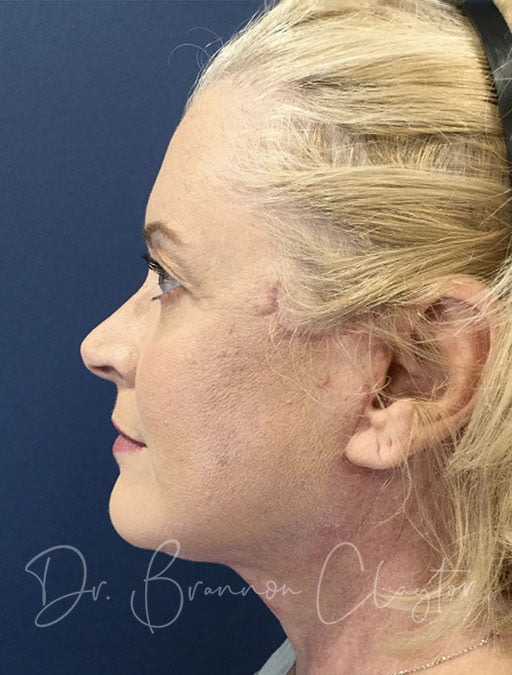 Facelift & Neck Liposuction