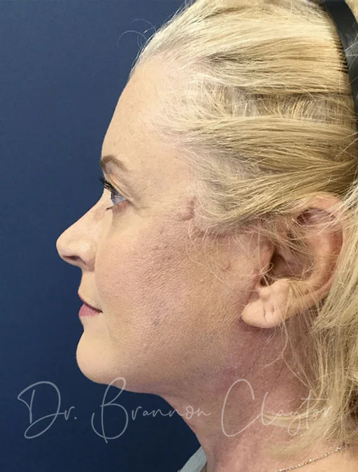 Facelift & Neck Liposuction