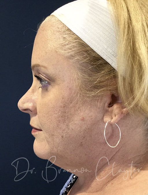 Facelift & Neck Liposuction