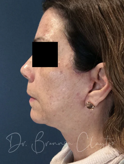 Facelift & Neck Liposuction