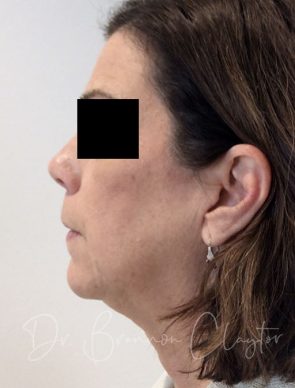 facelift-neck-liposuction-102b-before