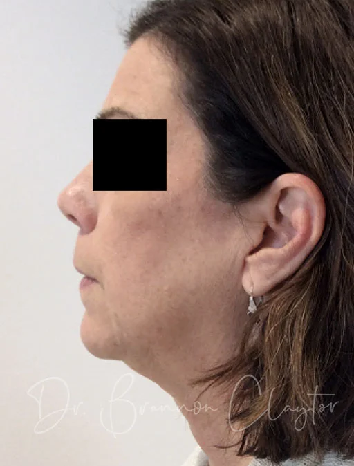 Facelift & Neck Liposuction