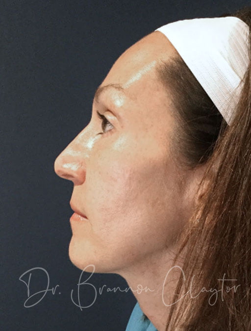 Rhinoplasty