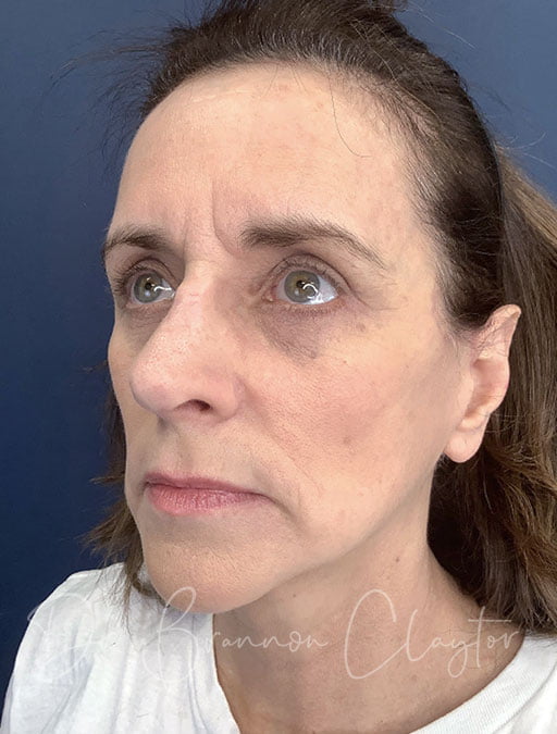 Rhinoplasty, Eyelid Lift, & Mini-Facelift