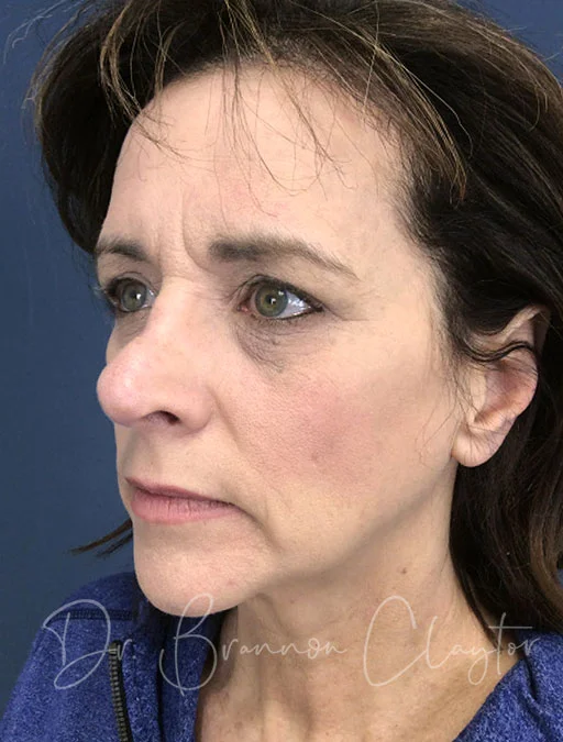 Rhinoplasty, Eyelid Lift, & Mini-Facelift