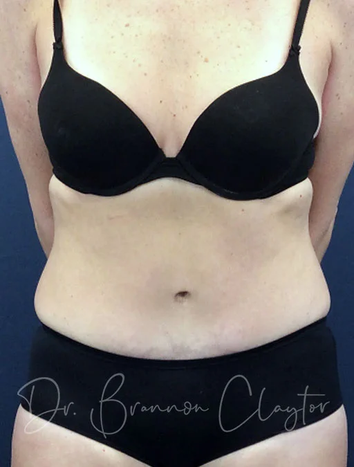 Tummy Tuck