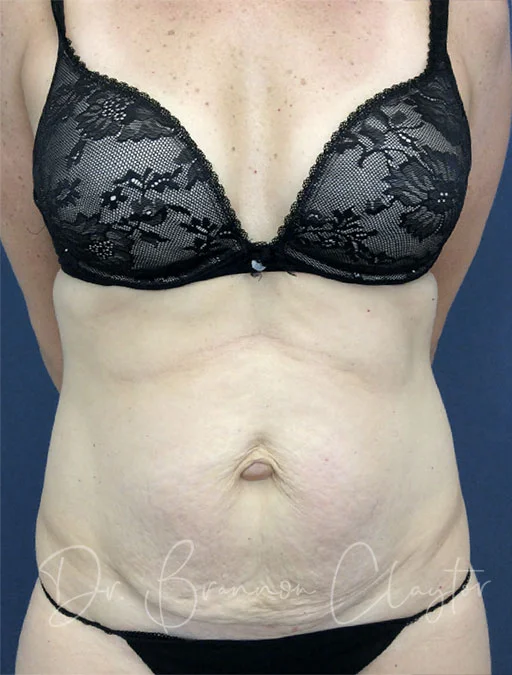 Tummy Tuck