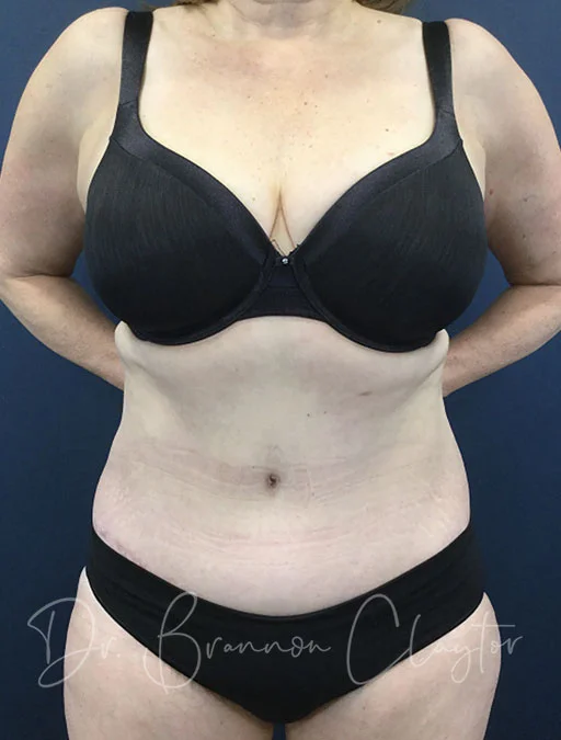 Tummy Tuck