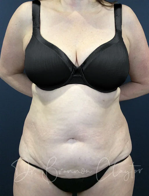 Tummy Tuck
