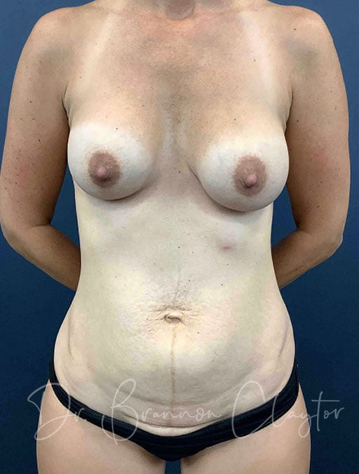 Tummy Tuck