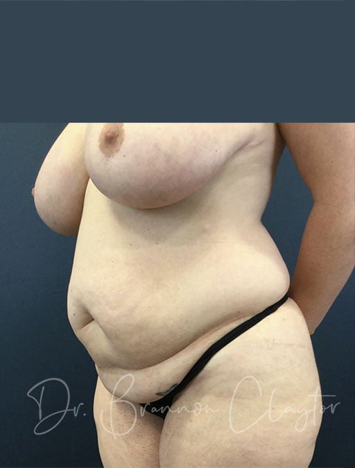 tummy-tuck-breast-reduction-102b-before