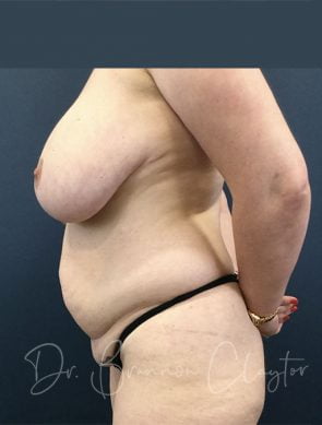 tummy-tuck-breast-reduction-102c-before
