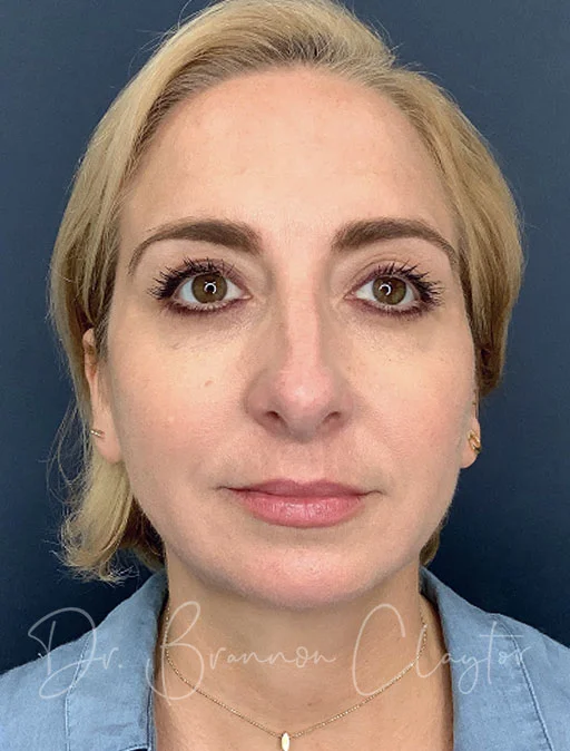 elevate-neck-lift-neck-smartlipo-chin-filler-47976a-after