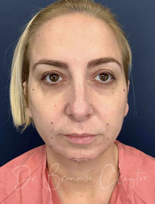 elevate-neck-lift-neck-smartlipo-chin-filler-47976a-before