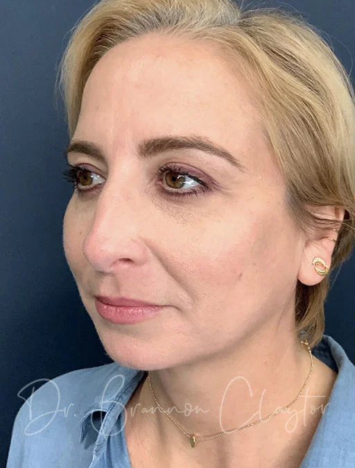 elevate-neck-lift-neck-smartlipo-chin-filler-47976b-after