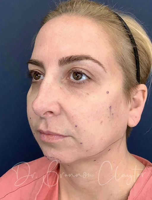 elevate-neck-lift-neck-smartlipo-chin-filler-47976b-before