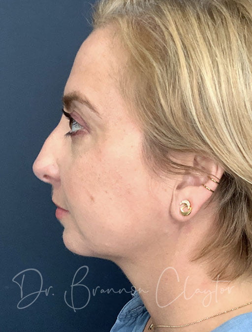 MyEllevate Neck lift, Smartlipo, & Chin Filler