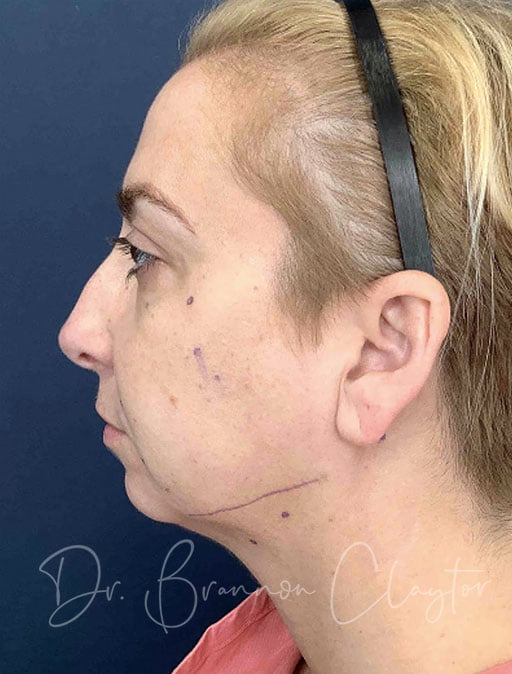 MyEllevate Neck lift, Smartlipo, & Chin Filler