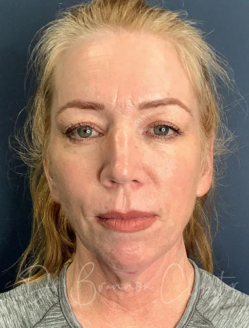 elevate-neck-lift-smartlipo-48612a-before