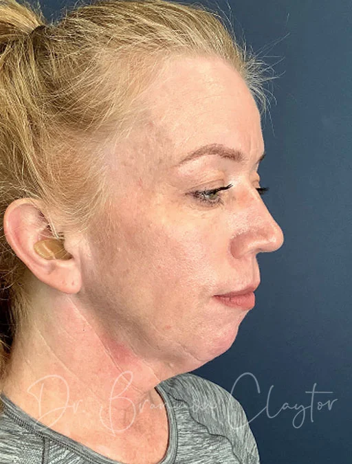 elevate-neck-lift-smartlipo-48612b-before