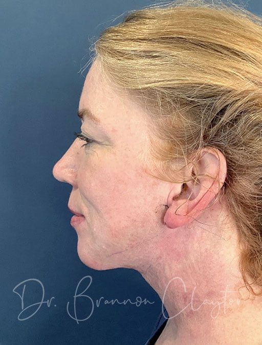 MyEllevate Neck Lift with Smart Liposuction