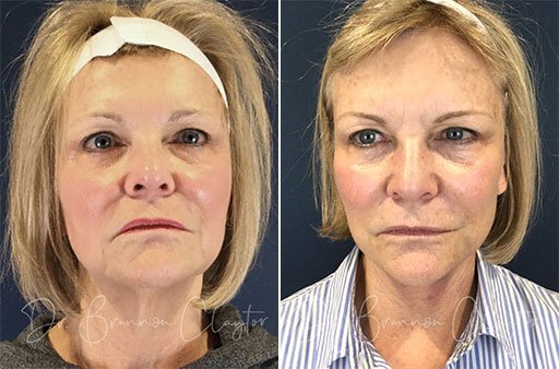 Facelift Before and After Patient