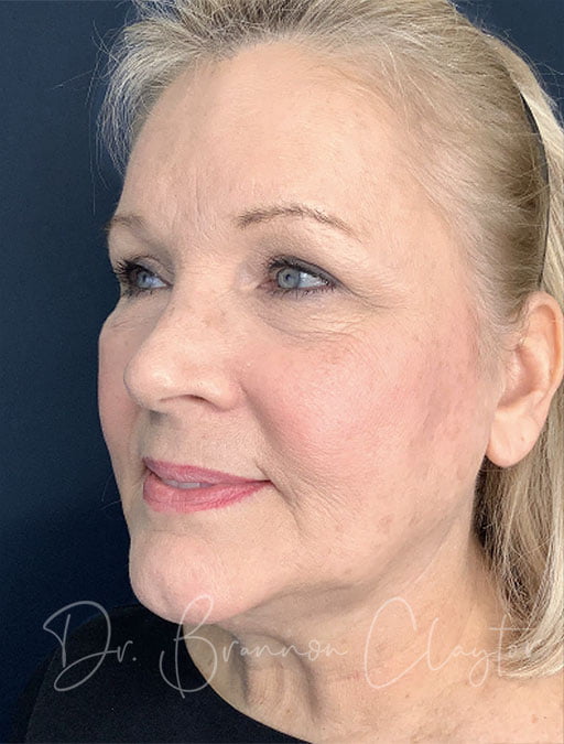 Facelift & Lower Eyelid Lift