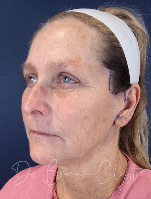 Facelift, Neck Liposuction & BLT Treatment