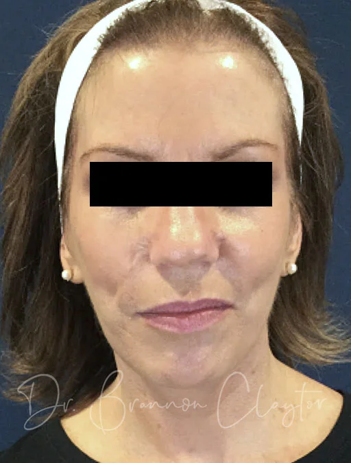 facelift-macs-neck-liposuction-45413a-after
