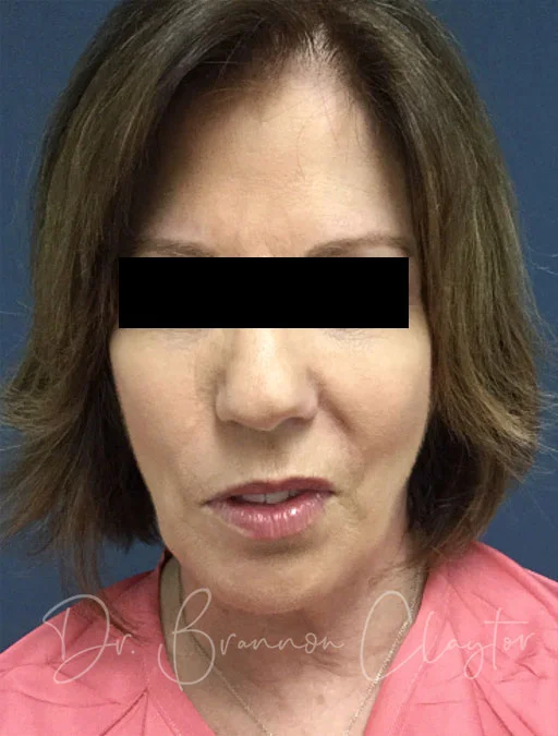 facelift-macs-neck-liposuction-45413a-before