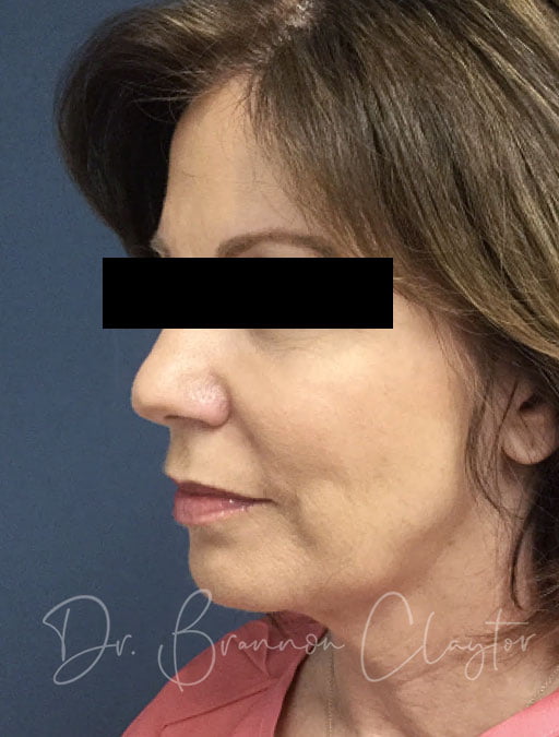 Facelift & Neck Liposuction