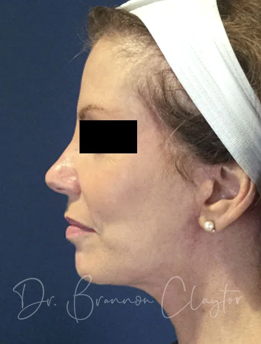 facelift-macs-neck-liposuction-45413c-after