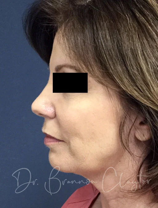 facelift-macs-neck-liposuction-45413c-before
