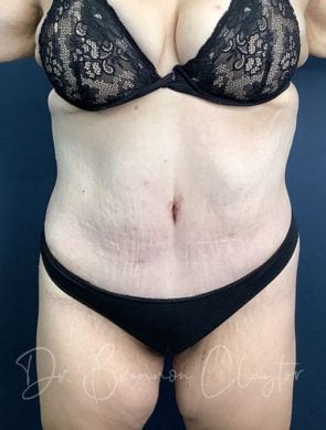 massive-weight-loss-tummy-tuck-48495a-after