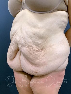massive-weight-loss-tummy-tuck-48495b-before