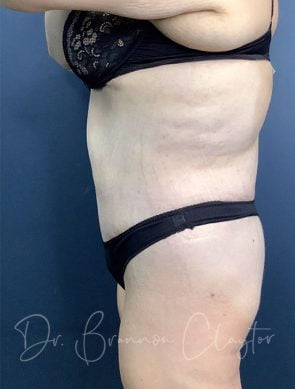 massive-weight-loss-tummy-tuck-48495c-after