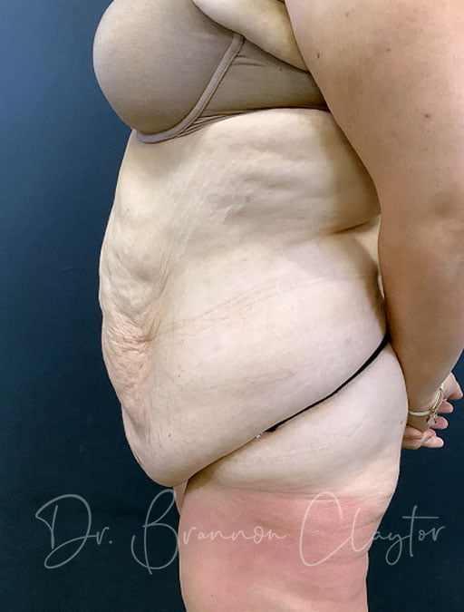 massive-weight-loss-tummy-tuck-48495c-before