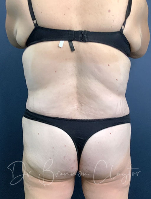massive-weight-loss-tummy-tuck-48495d-after