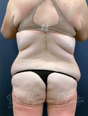 massive-weight-loss-tummy-tuck-48495d-before