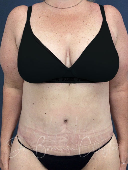 After Weight Loss Surgery